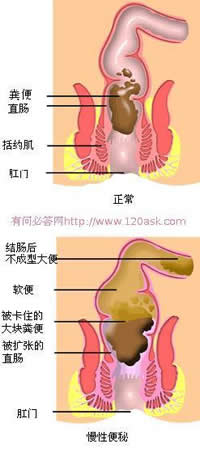 便秘结构图