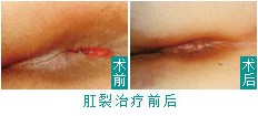肛裂.jpg