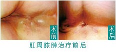 东大微创治疗肛周脓肿前后对比.jpg