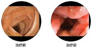 镜检下慢性直肠炎的治疗前后.jpg
