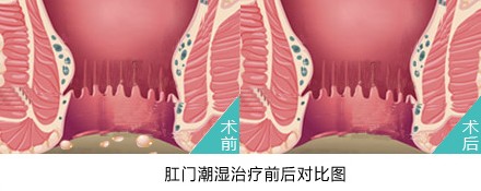 肛门潮湿.jpg