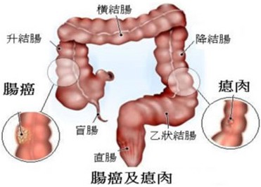 肠癌与息肉.jpg