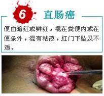 直肠癌出血.jpg