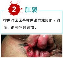 肛裂出血.jpg