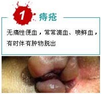 痔疮出血.jpg
