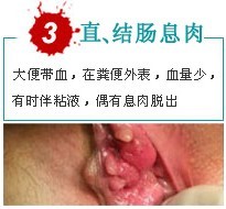 直.结肠炎出血.jpg