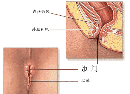 肛裂