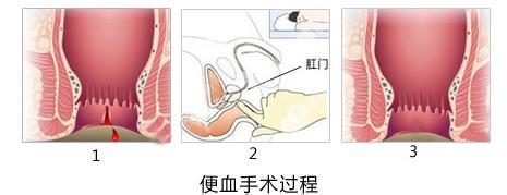 便血手术.jpg