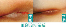 肛裂治疗前后.jpg