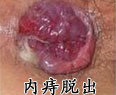 内痔脱出.jpg