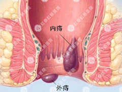 痔疮.jpg