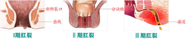 肛裂分期.jpg