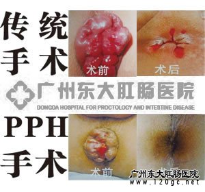 传统手术与PPH手术的效果对比