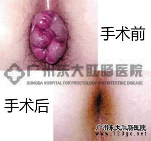 PPH治疗效果