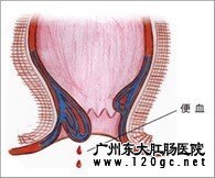 腹泻伴有便血可能昭示肠道炎症