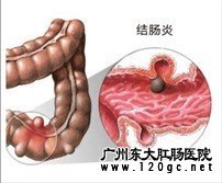结肠炎致腹泻示意图