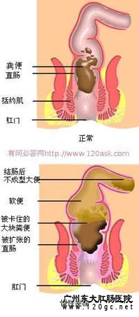 便秘结构图